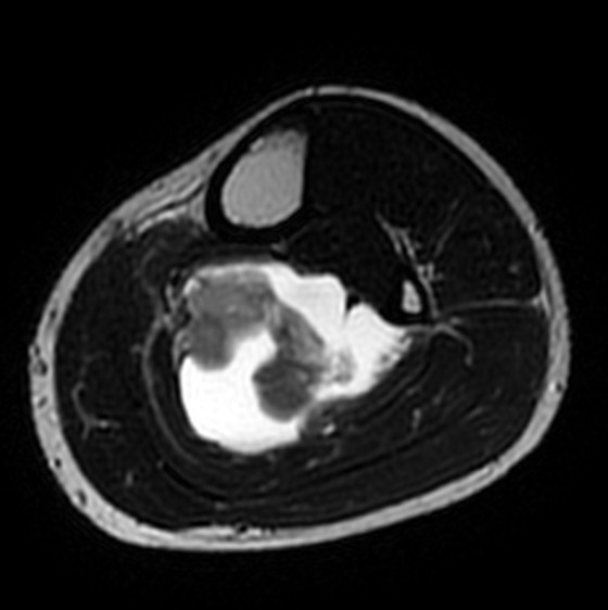 Axial T2 at the widest level