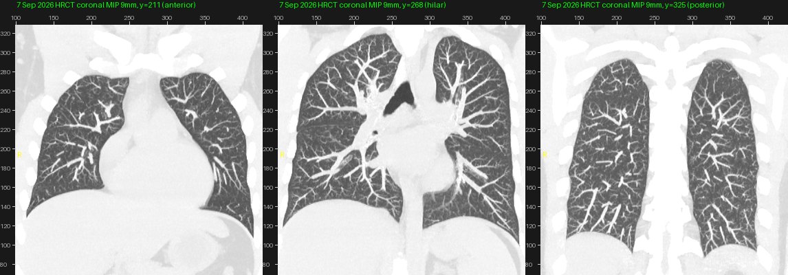 HRCT chest 7 Sep 2026, coronal 9 mm MIPs