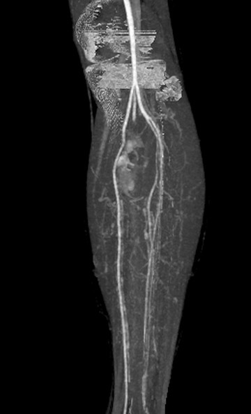 Arterial MIP (bone removed), frontal view
