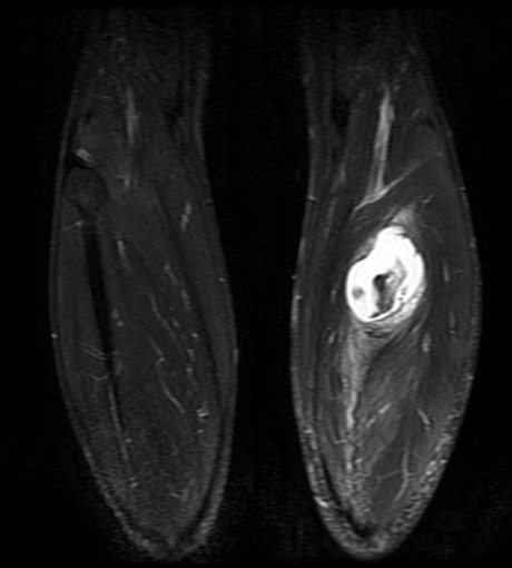 Coronal STIR, both legs