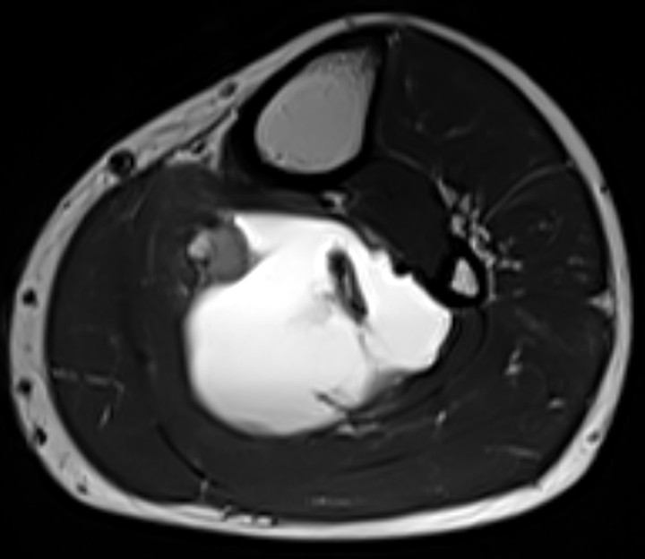 Axial T2 TSE, 9.5 cm below joint