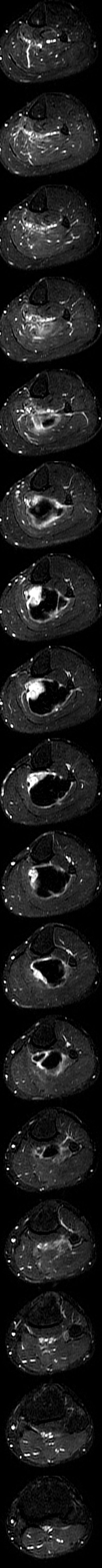 Kathmandu MRI · post-contrast subtraction