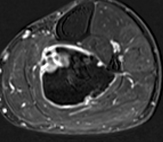 MRI 27 May, Subtraction, 10.5 cm below joint